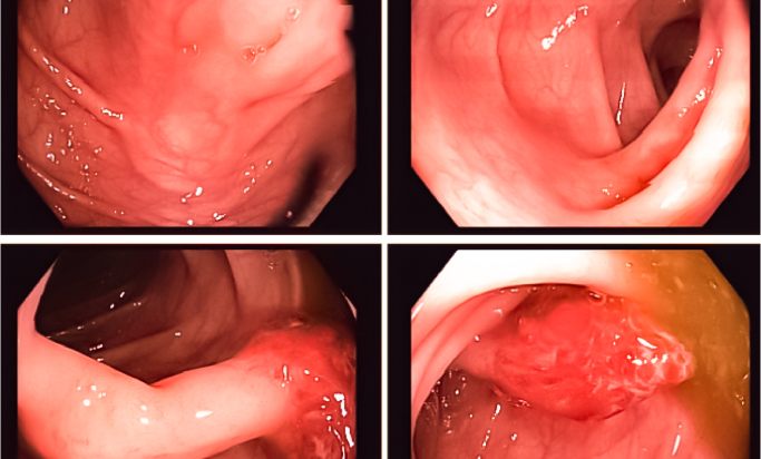 Video_Endoscopy_istockphoto-1415955443-1024x1024 1