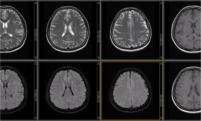 Image_3D_Brain MRI1_istockphoto-1172991934-1024x1024 1